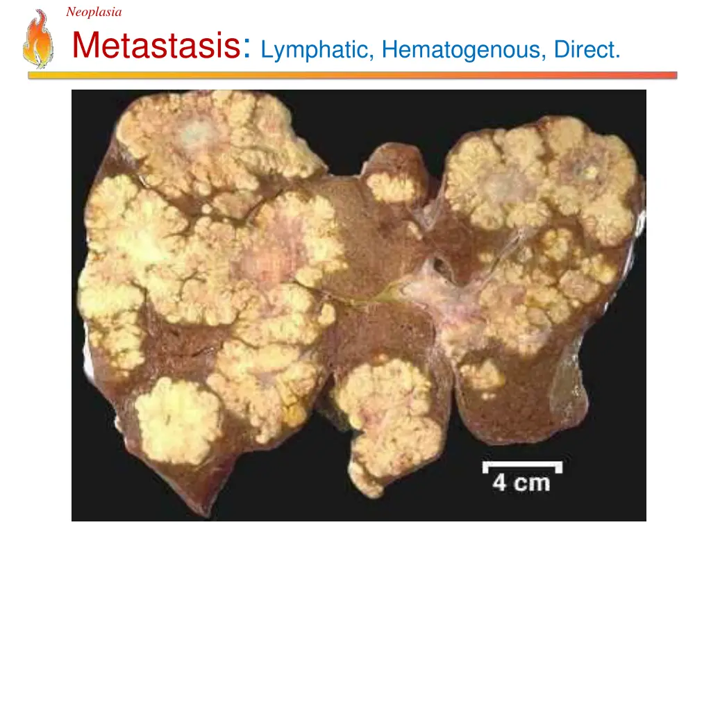 neoplasia metastasis lymphatic hematogenous direct