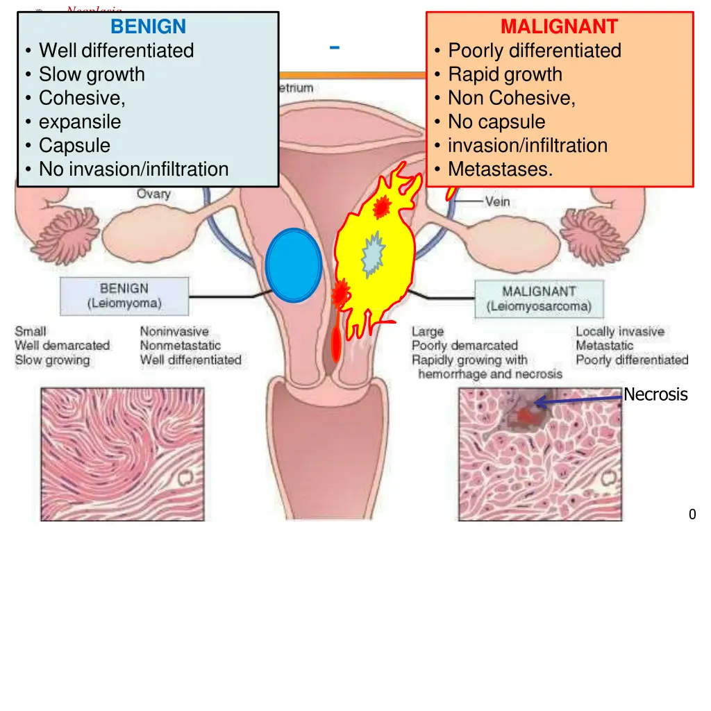neoplasia