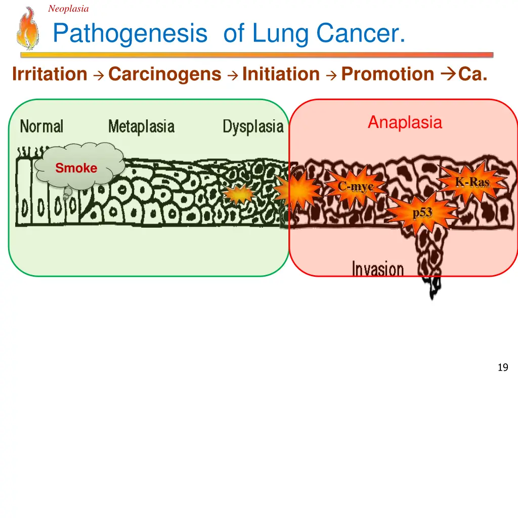 neoplasia pathogenesis of lung cancer