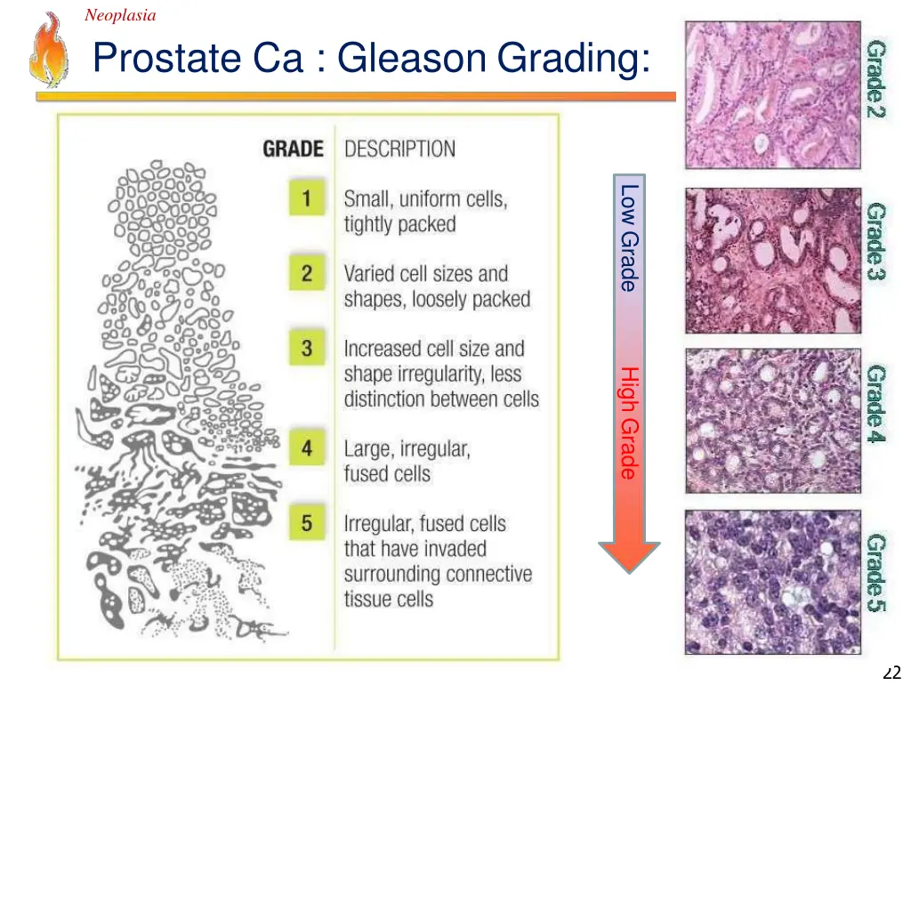 neoplasia prostate ca gleason grading