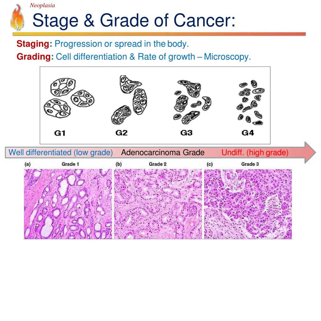 neoplasia stage grade of cancer