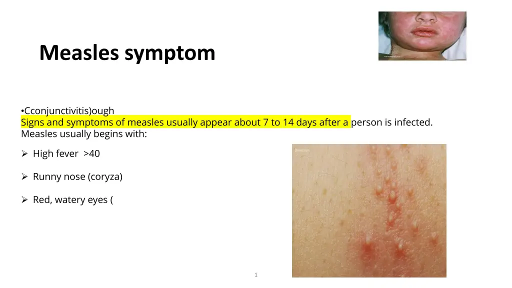 measles symptom