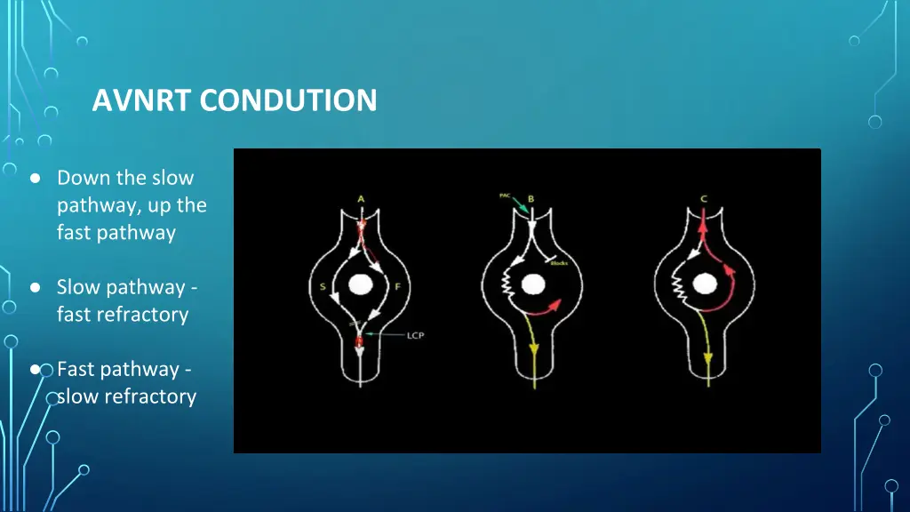 avnrt condution