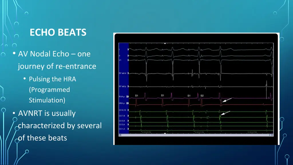 echo beats