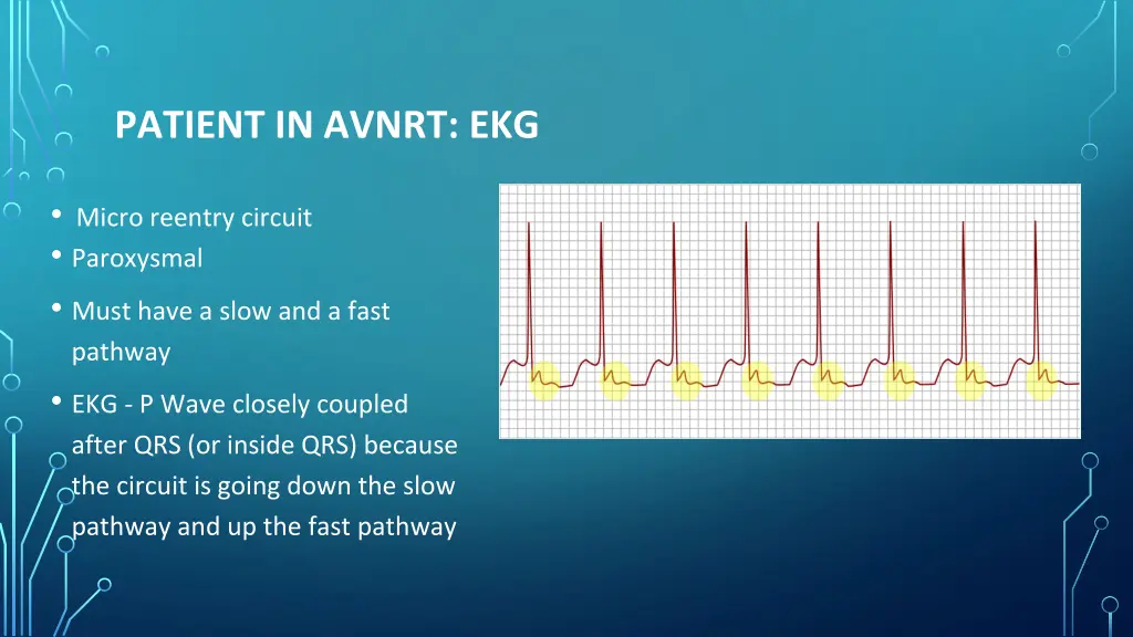 patient in avnrt ekg