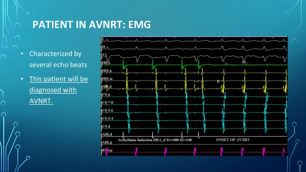 patient in avnrt emg