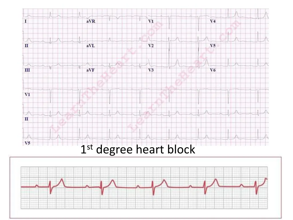 1 st degree heart block