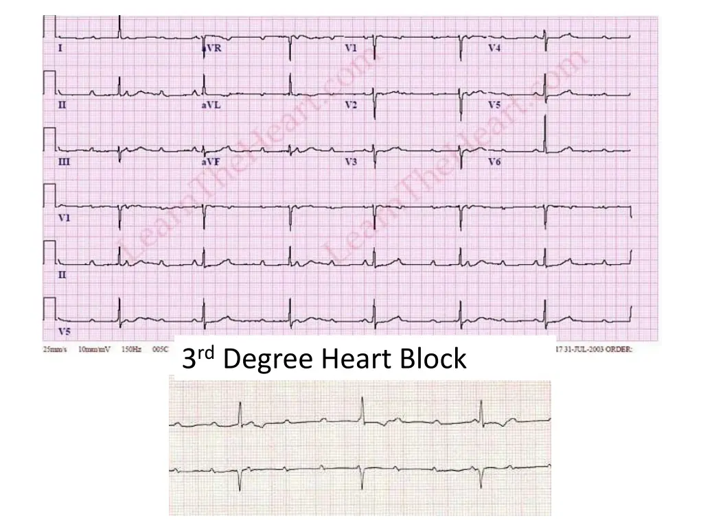 3 rd degree heart block