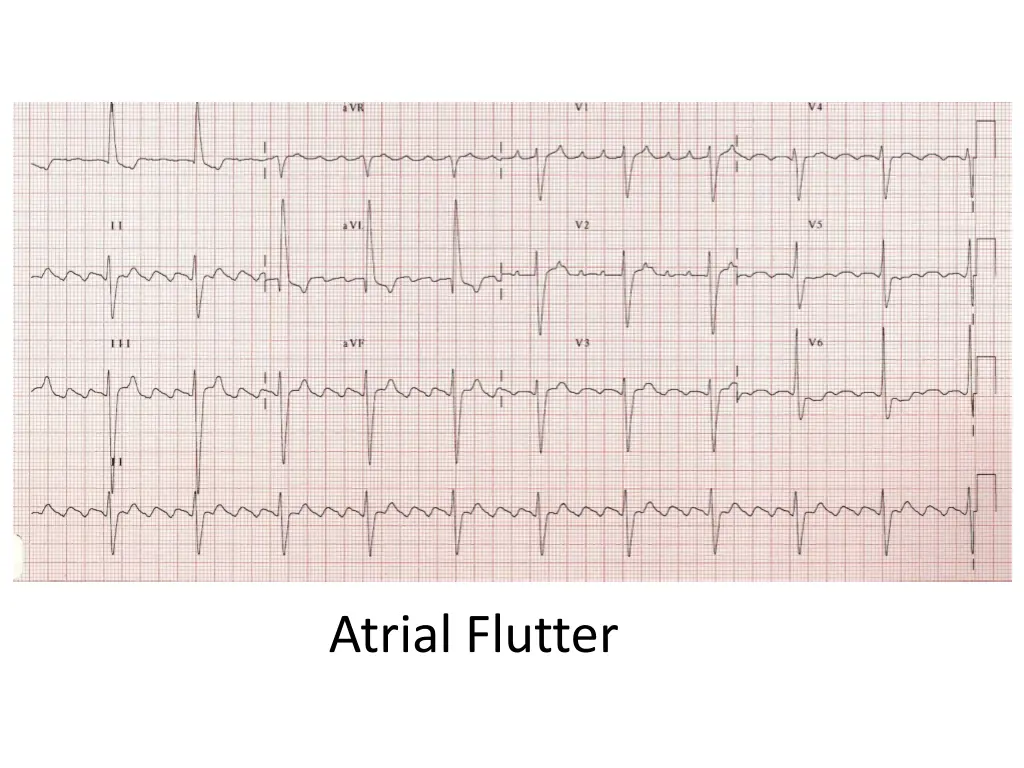 atrial flutter