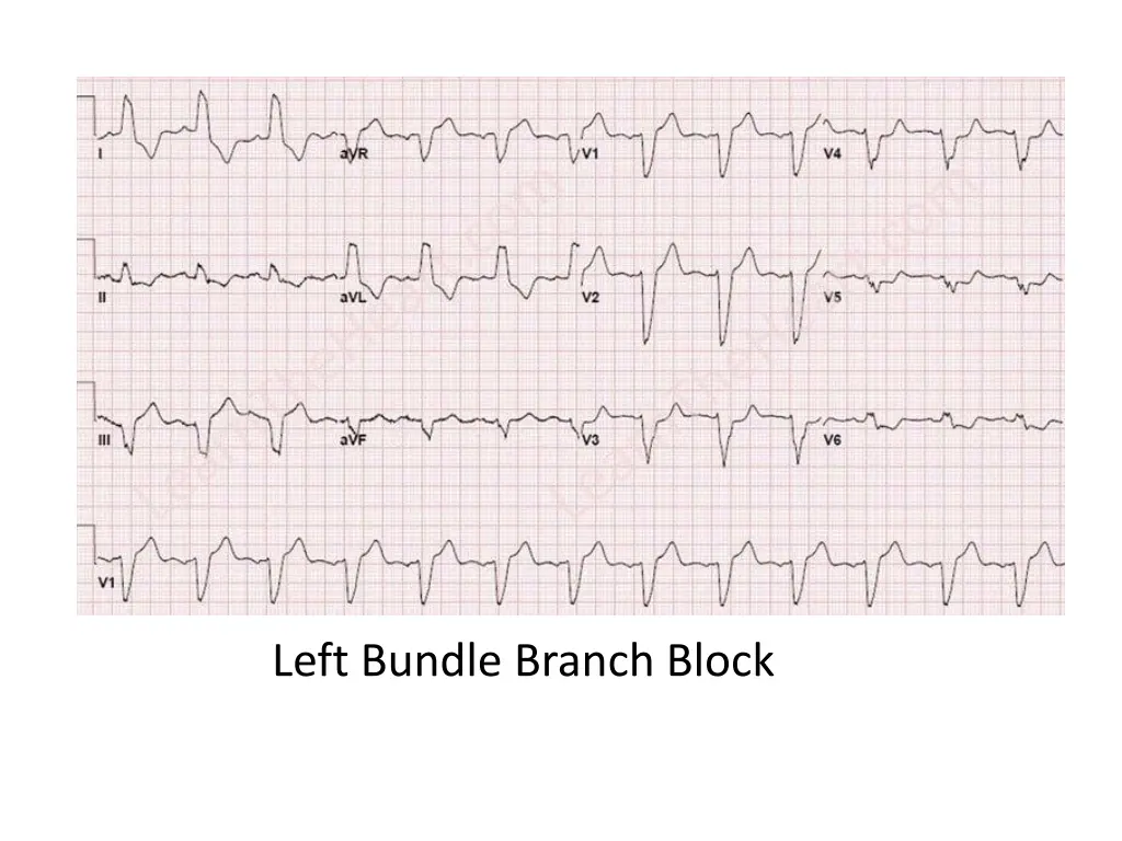 left bundle branch block
