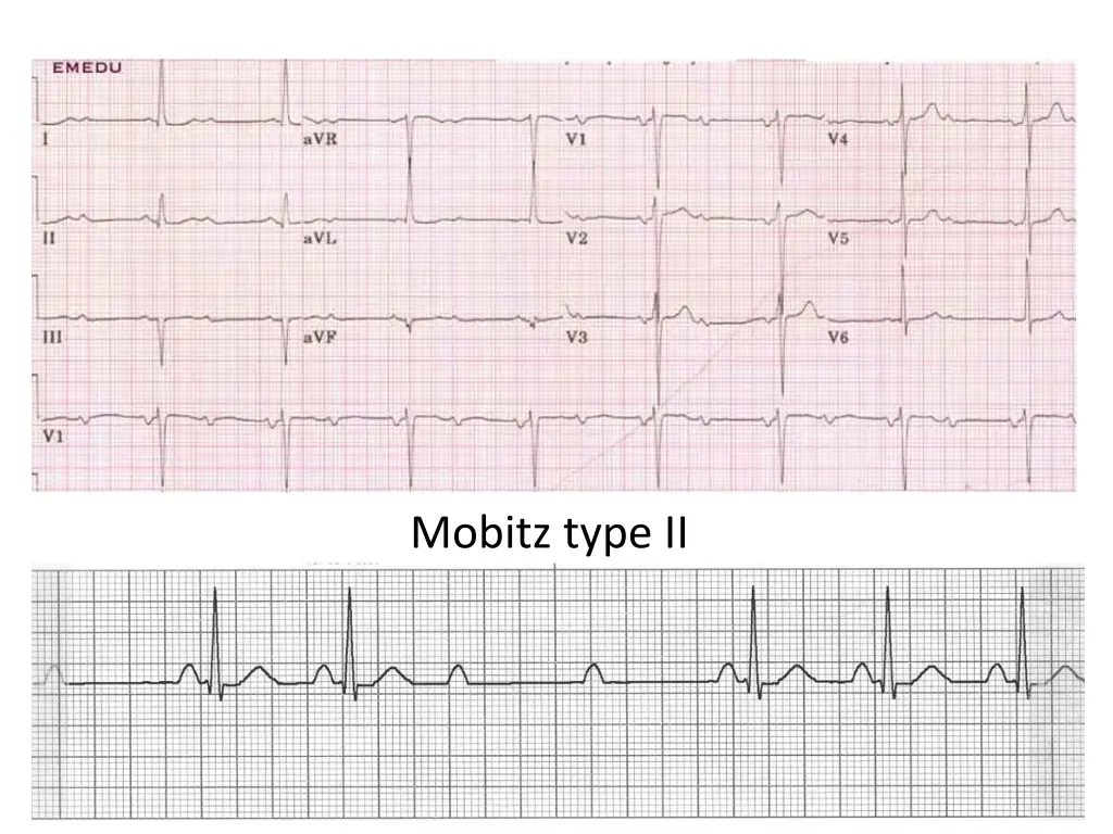mobitz type ii