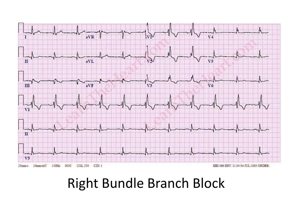 right bundle branch block