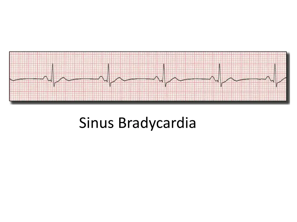 sinus bradycardia