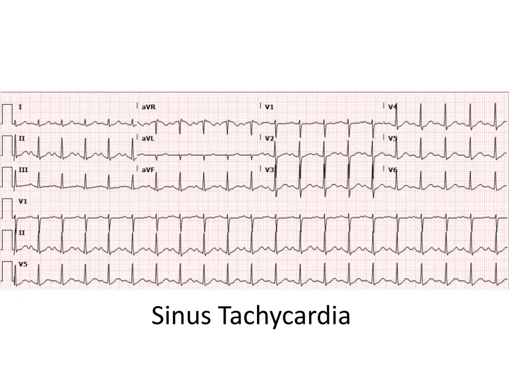 sinus tachycardia