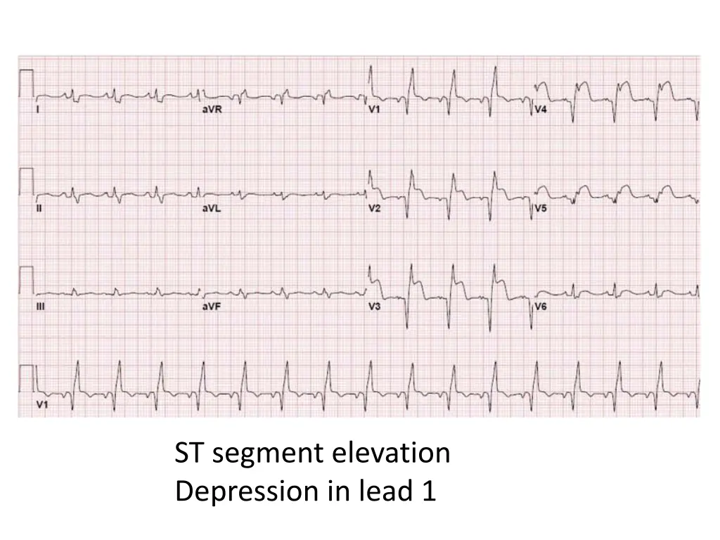 st segment elevation depression in lead 1