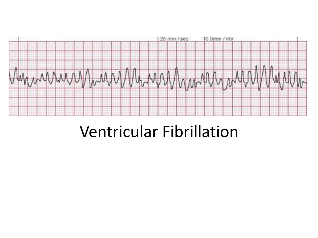 ventricular fibrillation