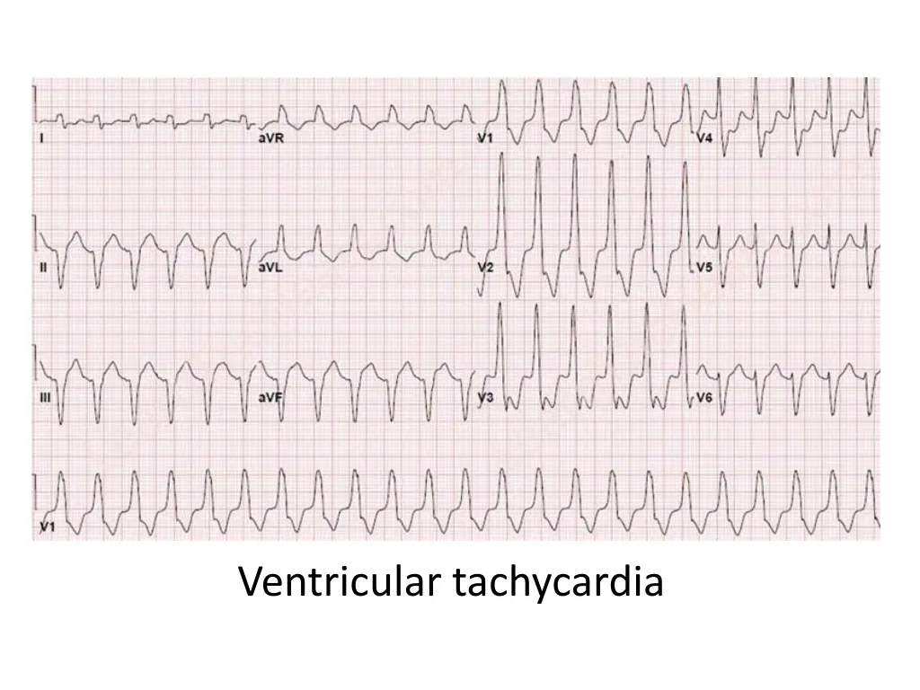 ventricular tachycardia