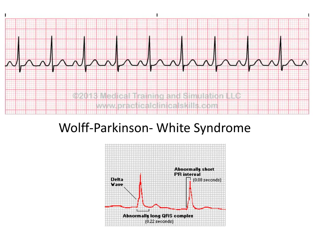 wolff parkinson white syndrome