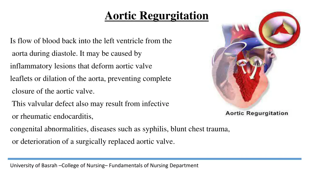 aortic regurgitation