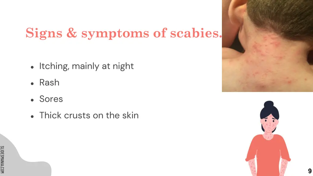 signs symptoms of scabies