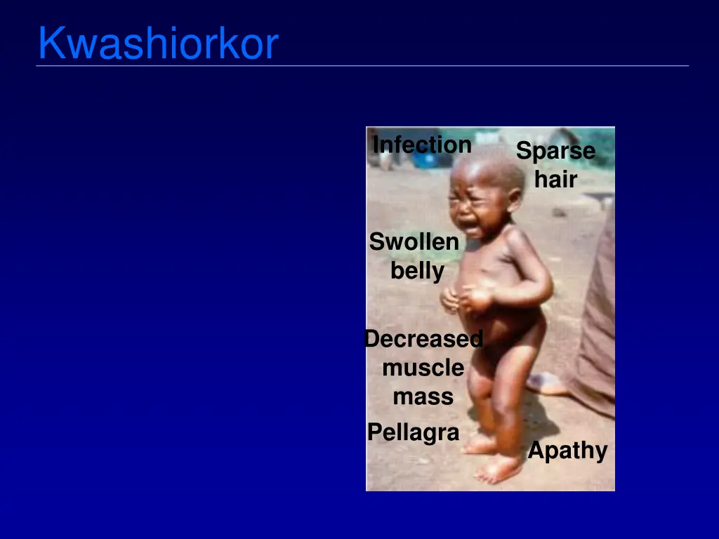 kwashiorkor