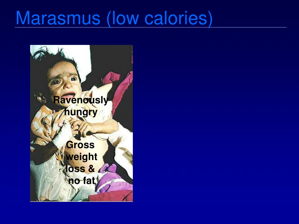 marasmus low calories