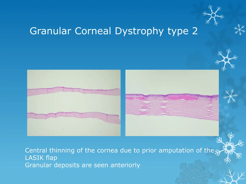 granular corneal dystrophy type 2 12
