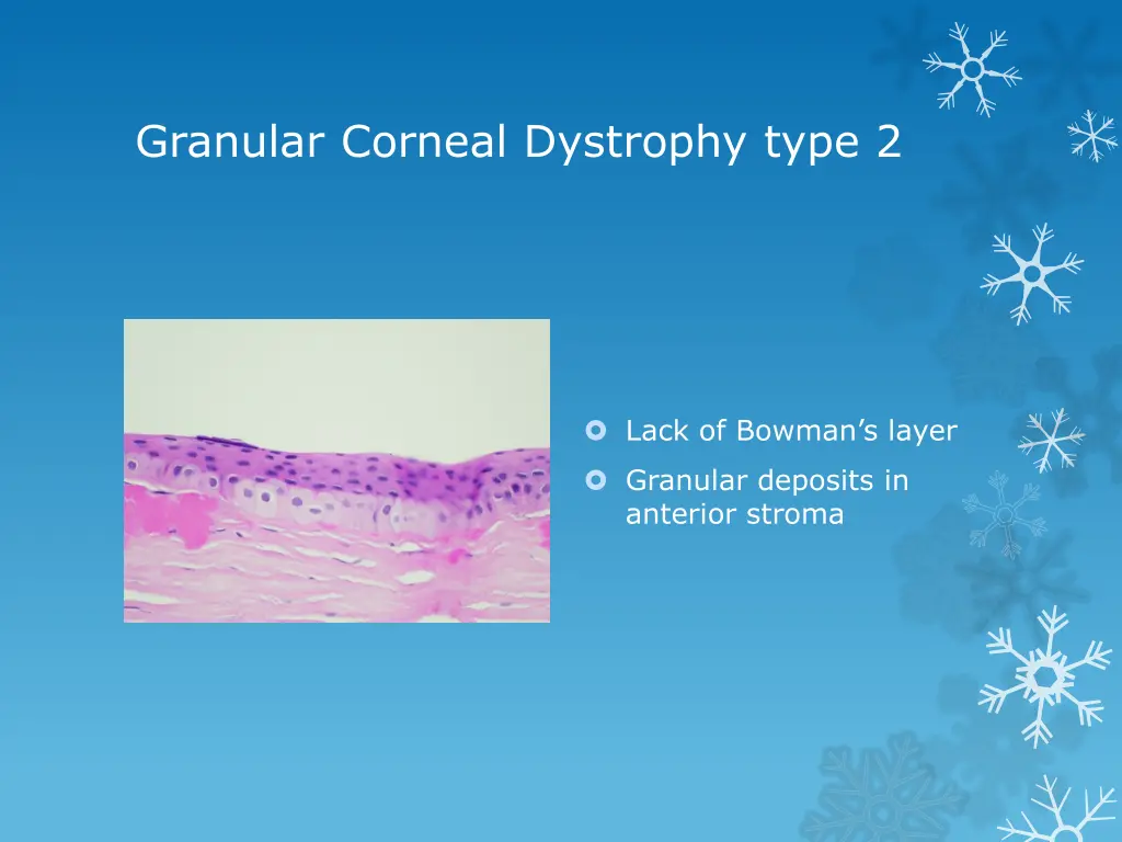 granular corneal dystrophy type 2 13