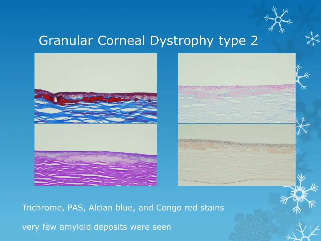 granular corneal dystrophy type 2 14