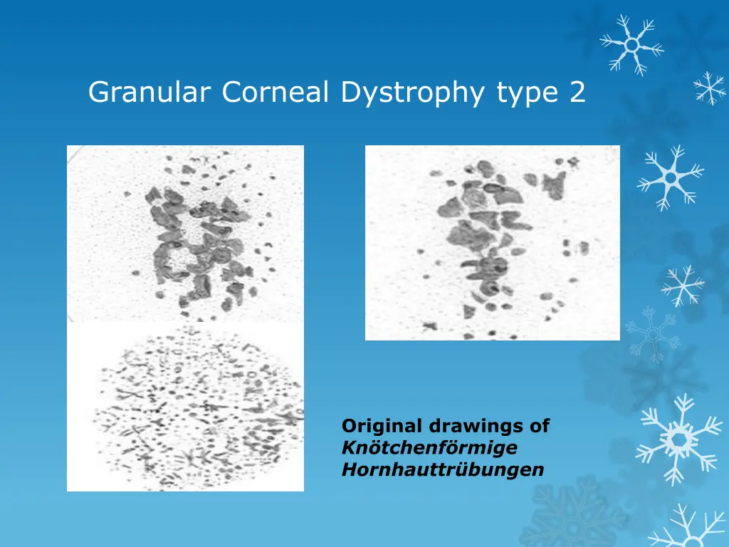 granular corneal dystrophy type 2 3