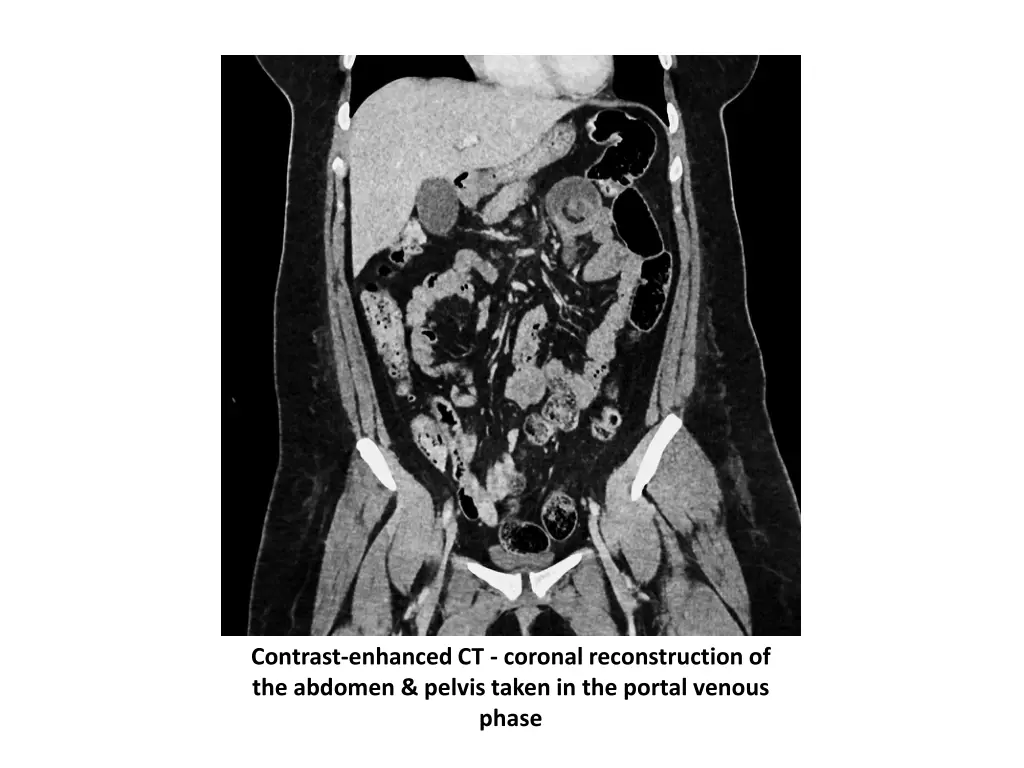 contrast enhanced ct coronal reconstruction