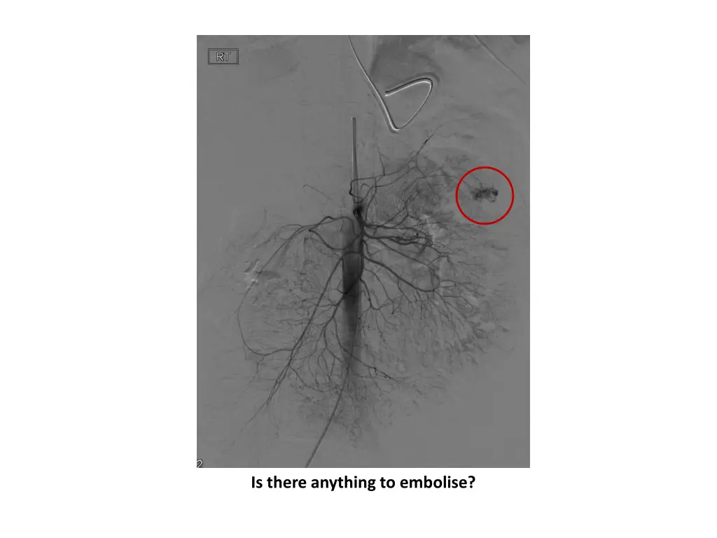 is there anything to embolise