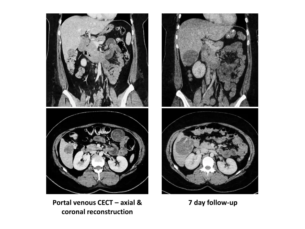 portal venous cect axial coronal reconstruction