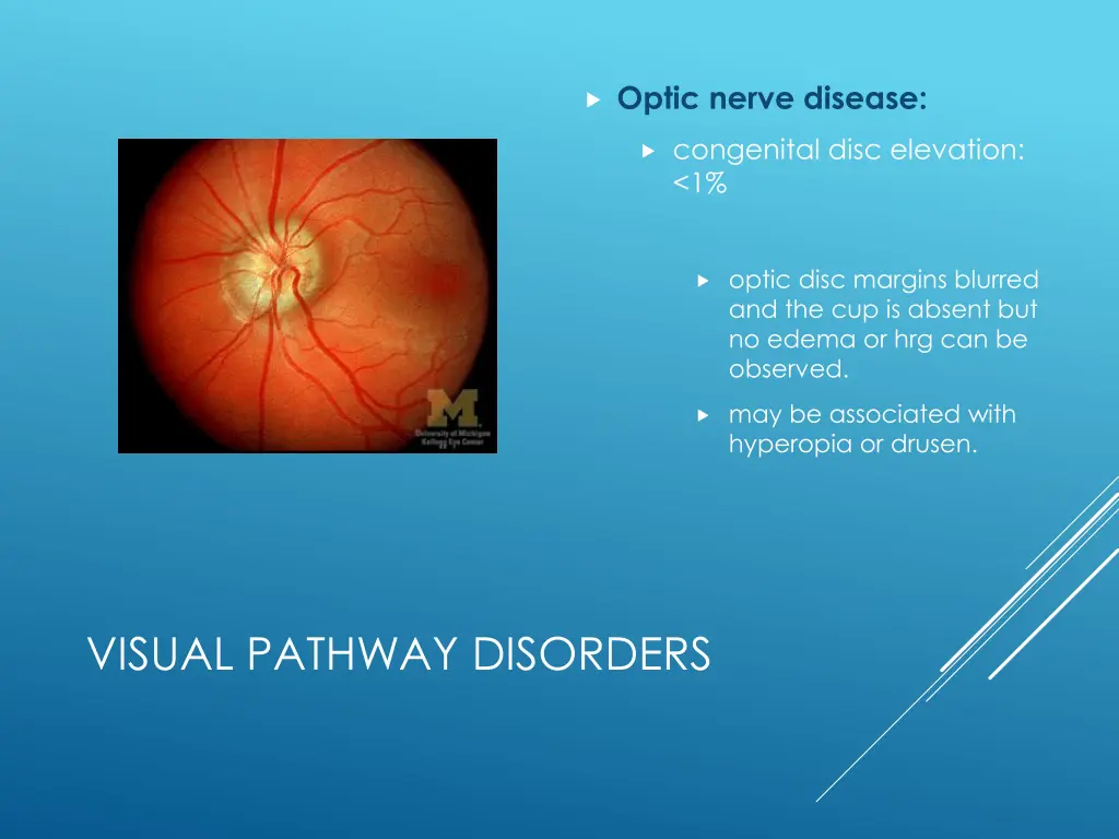 optic nerve disease 2