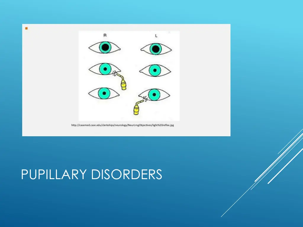 pupillary disorders