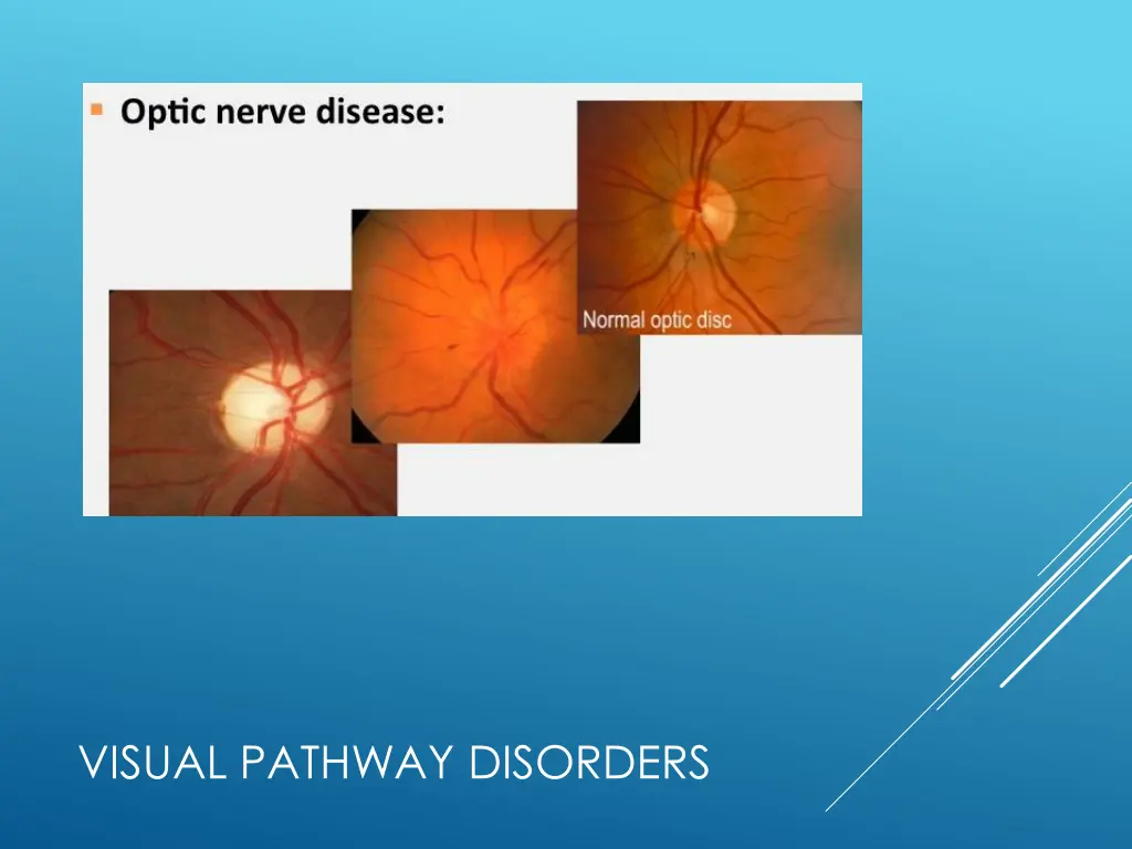 visual pathway disorders 1