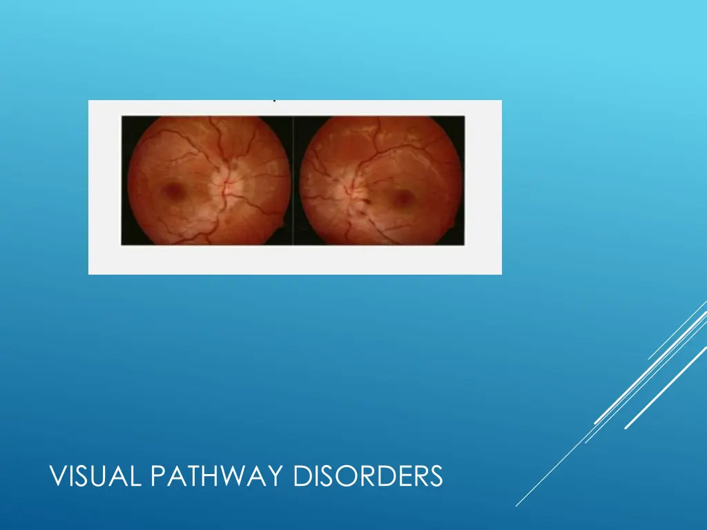visual pathway disorders 2