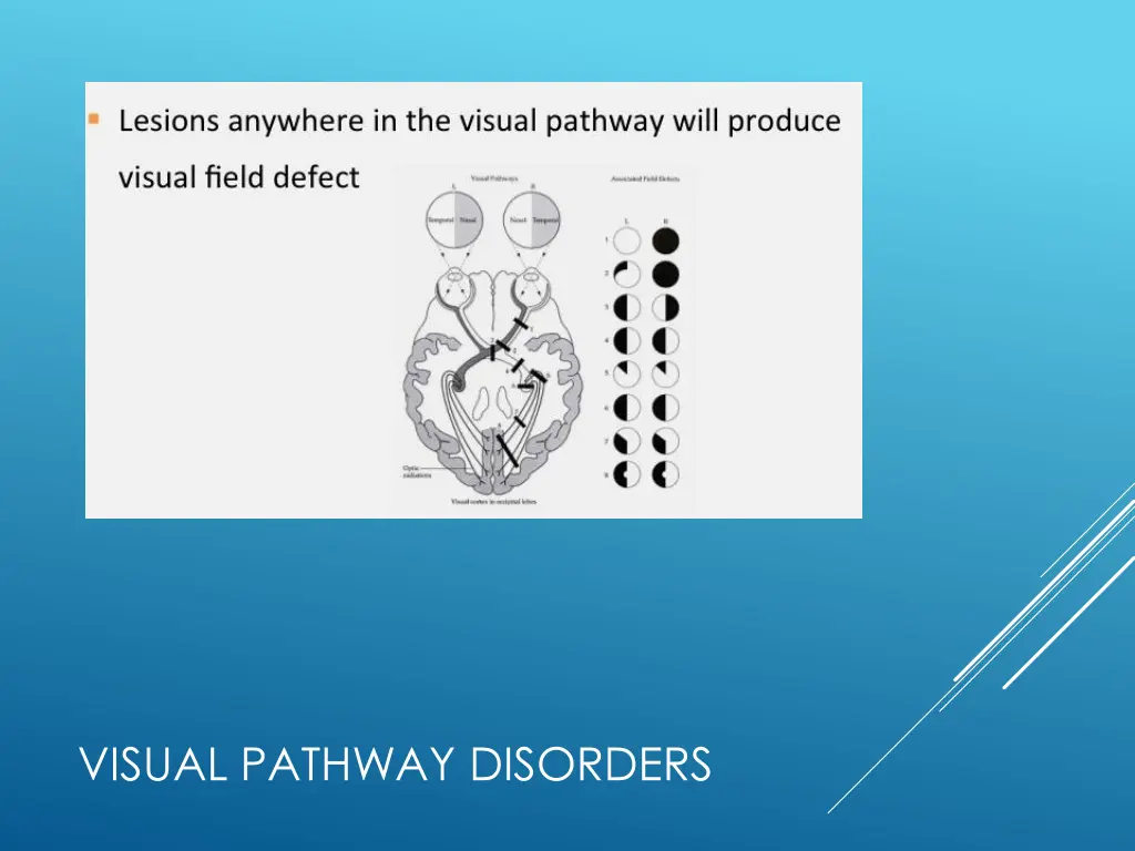 visual pathway disorders