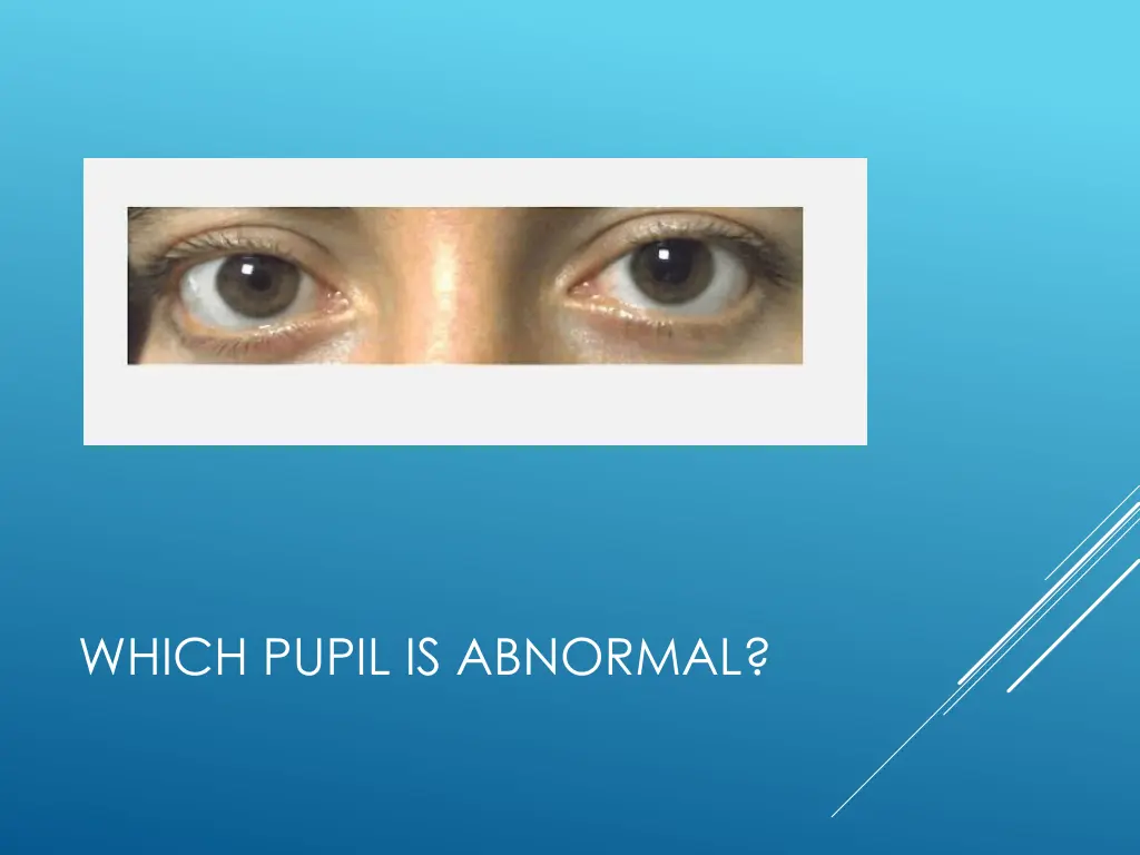 which pupil is abnormal
