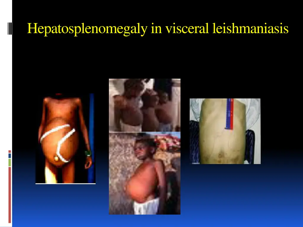 hepatosplenomegalyin visceral leishmaniasis