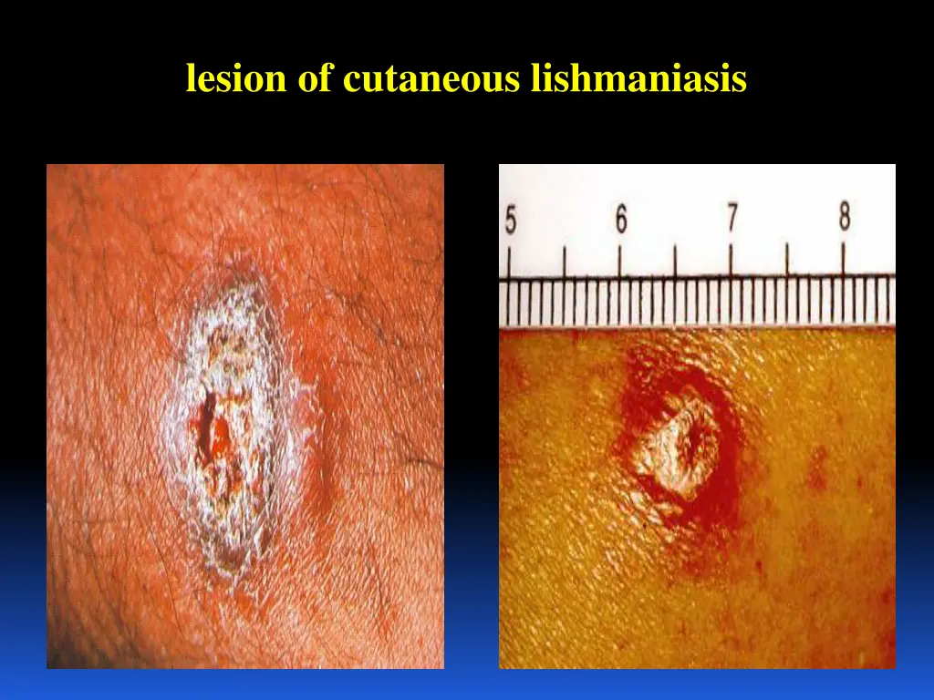 lesion of cutaneous lishmaniasis