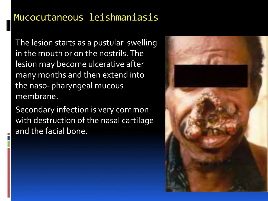 mucocutaneous leishmaniasis