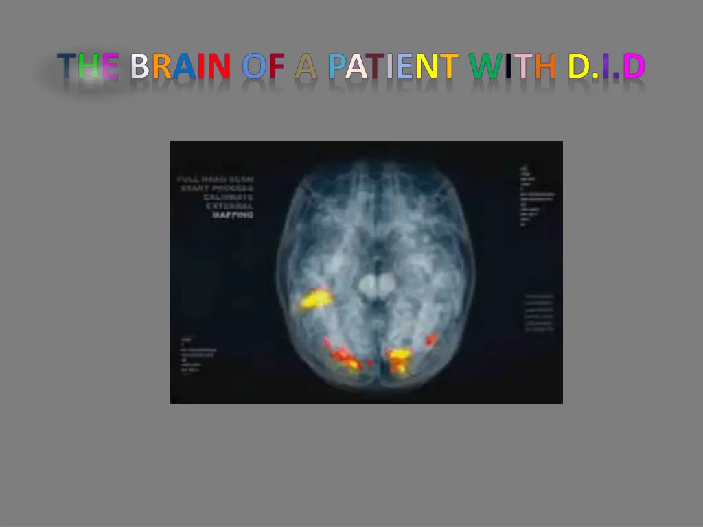the brain of a patient with d i d