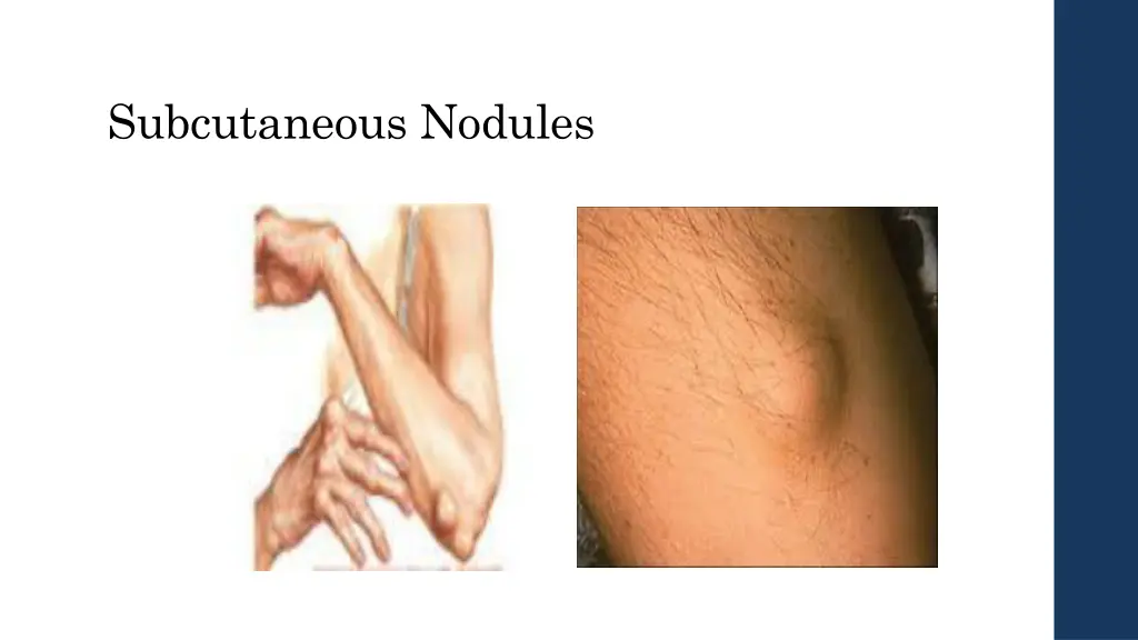 subcutaneous nodules 1