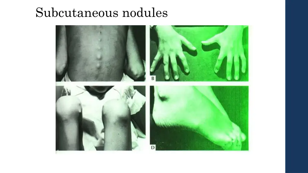 subcutaneous nodules