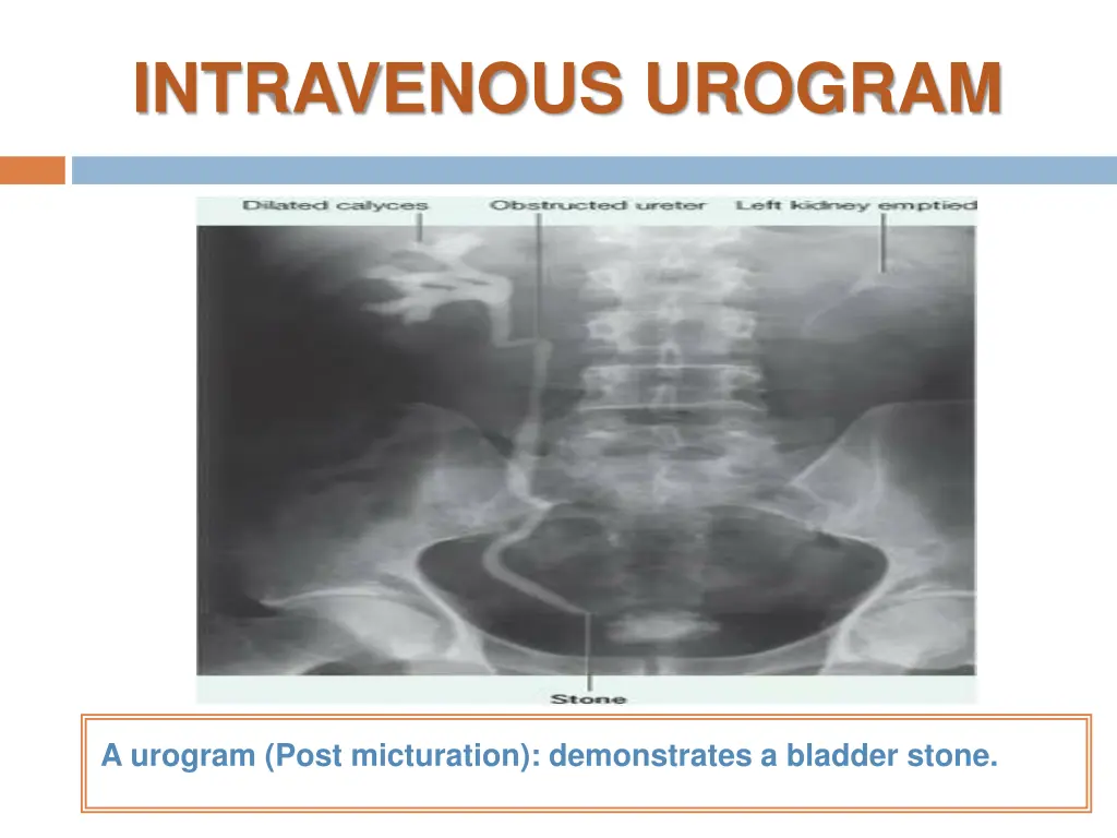 intravenous urogram