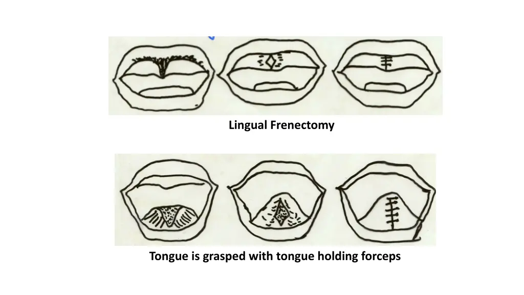 lingual frenectomy