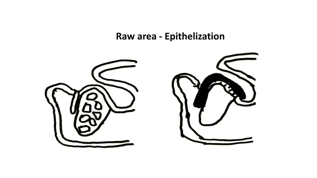 raw area epithelization