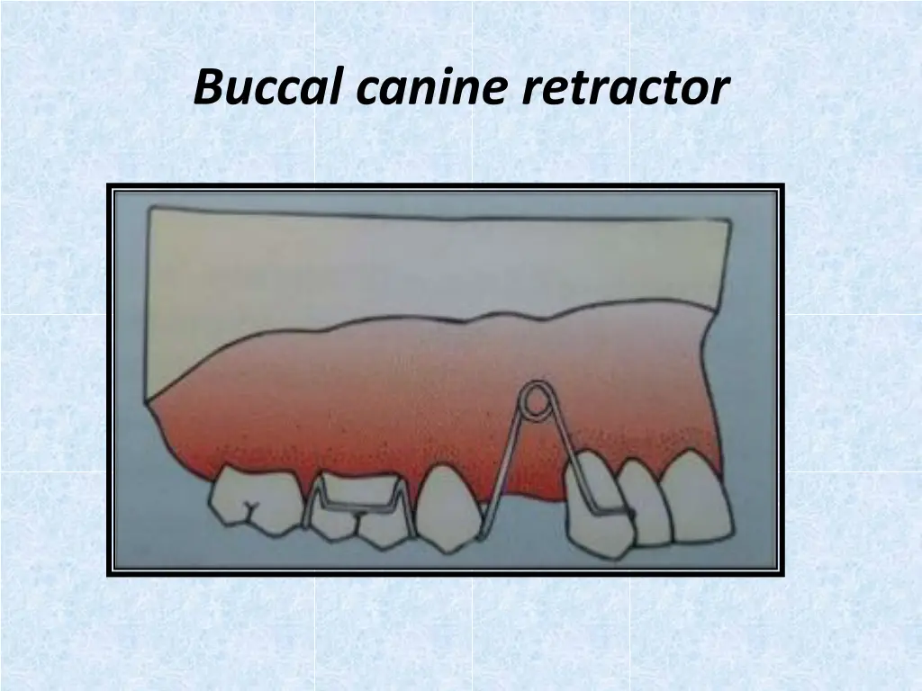 buccal canine retractor 1