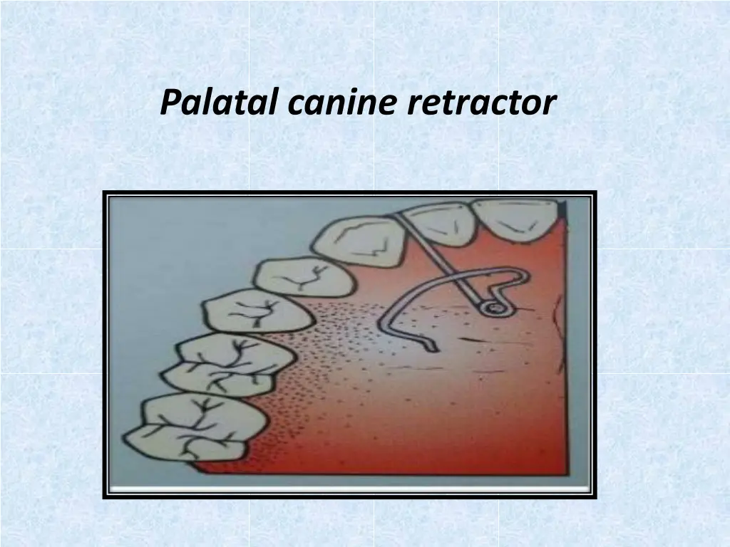 palatal canine retractor 1